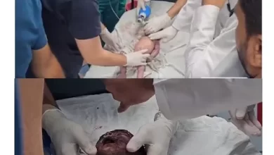 Doctors try to revive the baby