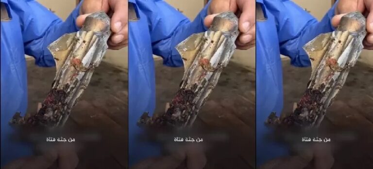 The bones and flesh cover the fragments… the extraction of a shell from the body of a martyred girl in Gaza