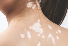 Vitiligo treatment breakthrough